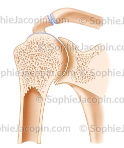ARTHROPATHIE HÉMOPHILIQUE ÉPAULE