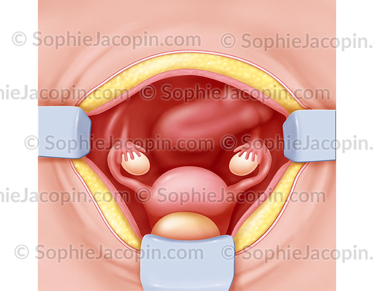 HYSTÉRECTOMIE PAR VOIE ABDOMINALE