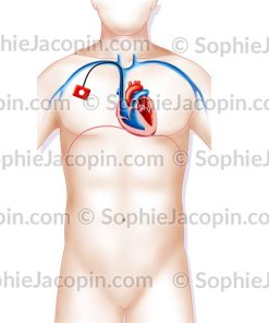 CHAMBRE IMPLANTABLE PERCUTANÉE