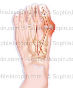 HALLUX VALGUS