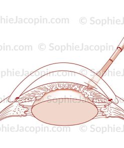 PHACOÉMULSIFICATION INCISION