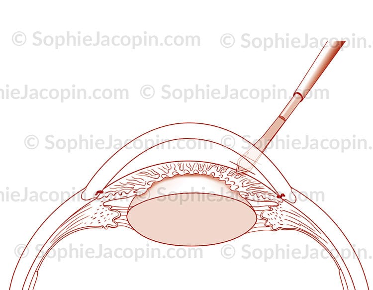PHACOÉMULSIFICATION INCISION