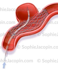 TRAITEMENT ANÉVRISME ASSISTÉ PAR STENT