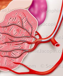 EMBOLISATION PROSTATE