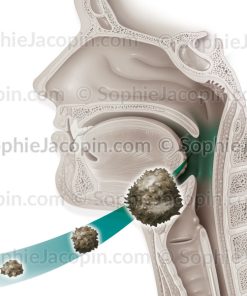 CANCER OROPHARYNGÉ