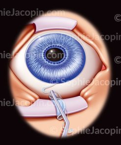 IMPLANT INTRAOCULAIRE