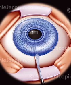 IMPLANT INTRAOCULAIRE- INCISION