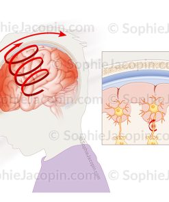 LÉSIONS AXONALES DIFFUSES